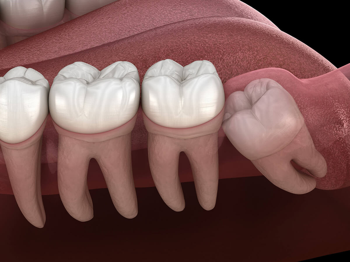 Wisdom Teeth Removal Deerfoot Dental Pinson, AL