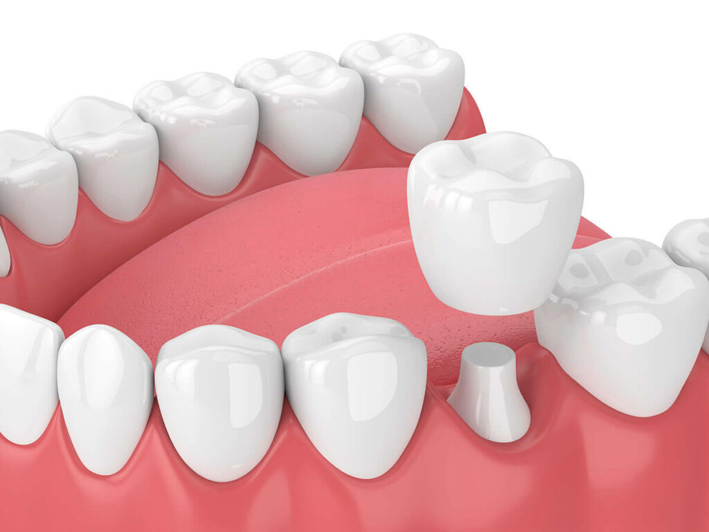 graphic of a dental crown