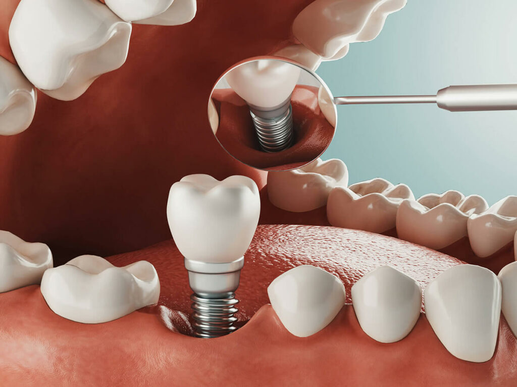 graphic of a dental implant