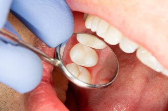 Close-up of dental examination showing gloved hand holding a mirror to inspect clean molar teeth inside the mouth.